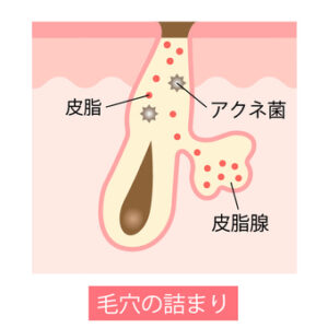 毛穴詰まり　ニキビ