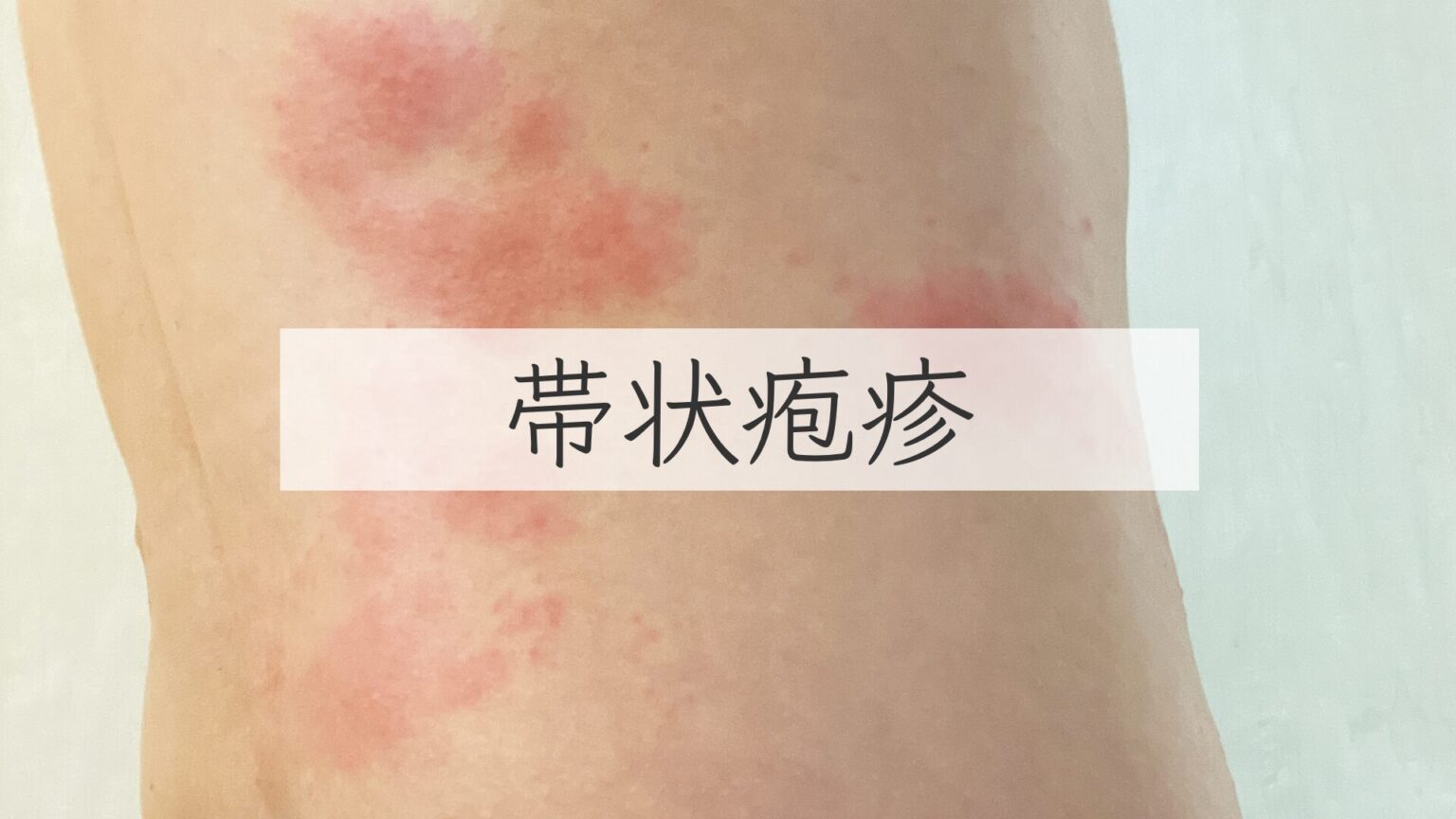 帯状疱疹の痛みのピークはいつですか?