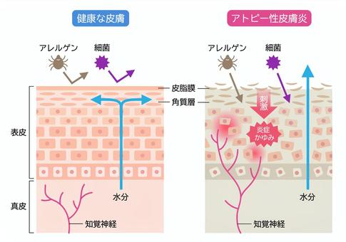 【アトピー性皮膚炎】アトピー の原因と治し方、一般的な薬ステロイド について皮膚科医が完全解説!! | 皮膚科疾患&治療辞典