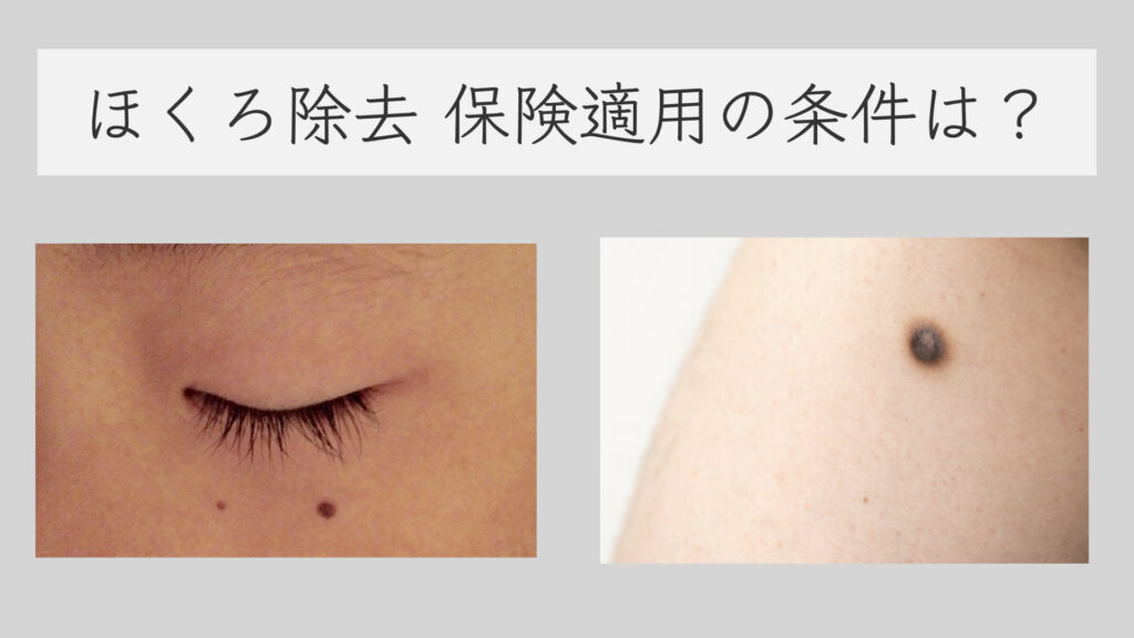 【皮膚がんの見分け方】こんな「ほくろ」の症状があったら絶対見逃さないで！皮膚癌 の初期症状について皮膚科医が解説【脂漏性角化症、日光黒子 ...